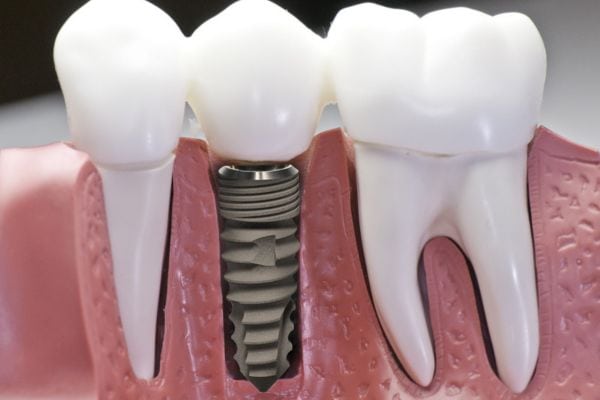 Chi phí cấy ghép implant phụ thuộc vào nhiều yếu tố